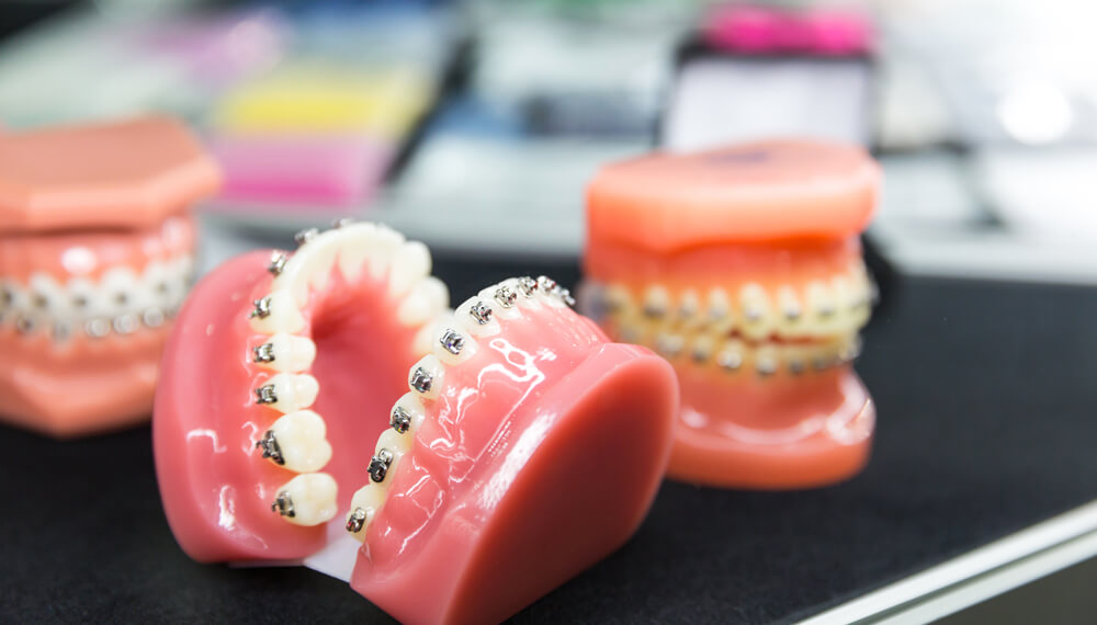 Advancing Dental Prosthetics with 3D Printed Resin Dental Models